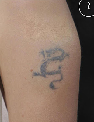  Removetatto on Angelina Jolie Tattoo Removal Before And After Pictures   Tattoo