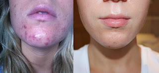 Epiduo+Before+After+Acne.JPG