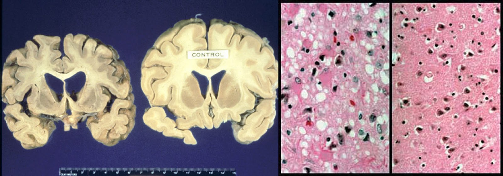 ffi disease ffi disease