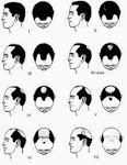 Fases alopecia
