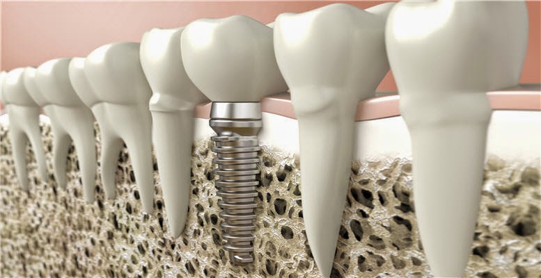 implant dentaire avantages et inconvénients