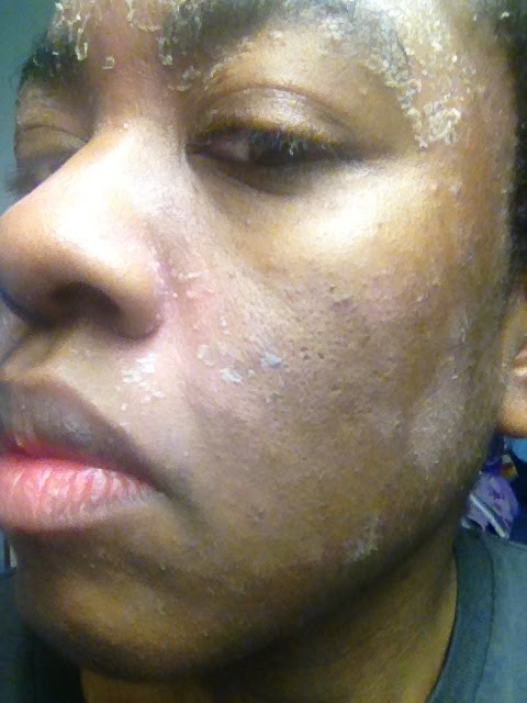 Laurel S Blog Warning The Famous Proactiv Skin Cleanser Ruined My Skin