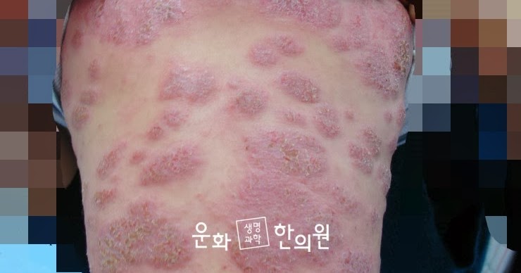 新しいアトピー治療法（1） 子供と一緒に私も泣きました