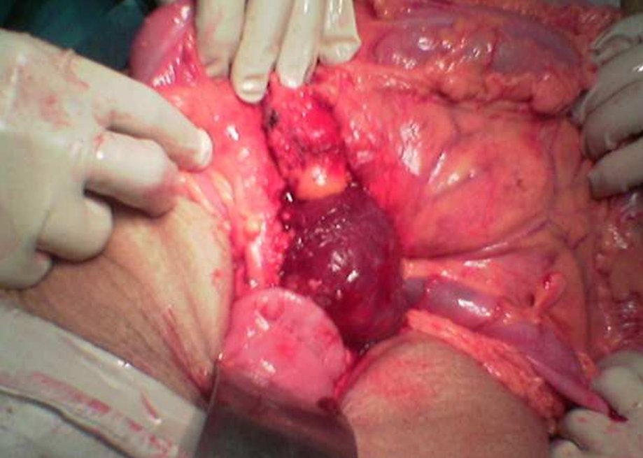 Stromal Tumor