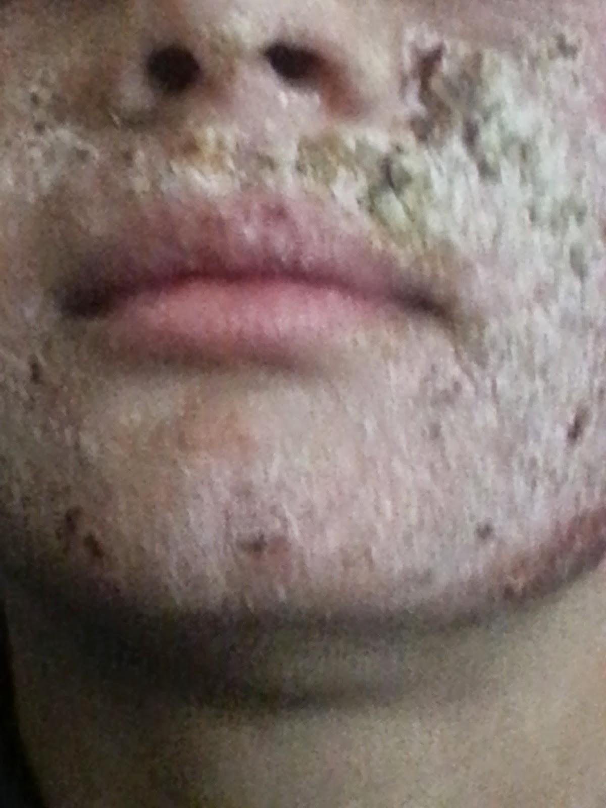 Steroids Make Eczema Worse 5 months in...