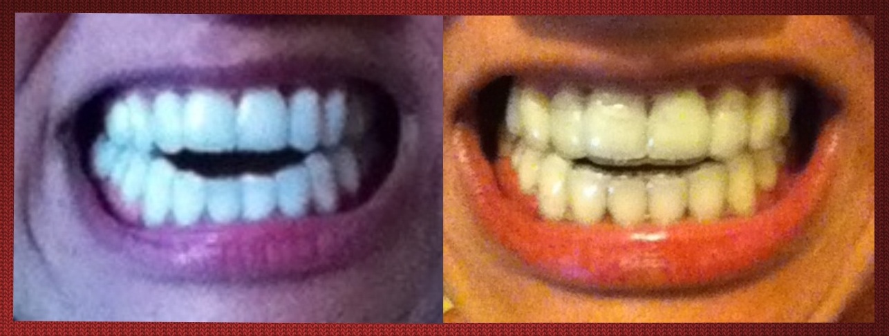 bite invisalign open tray anterior severe story