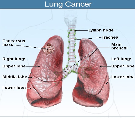 Image result for lung cancer causes symptoms and prevention