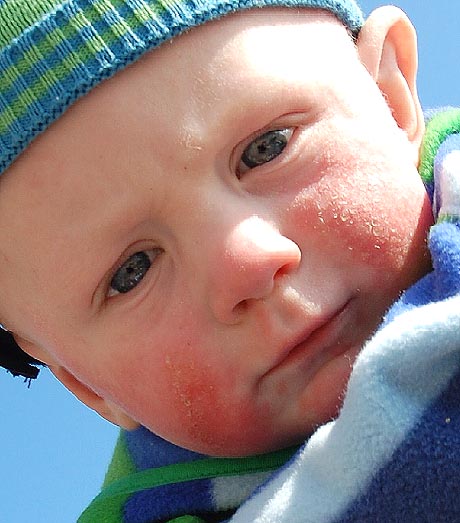 Vaccine Injury Eczema Vaccine Injury Eczema