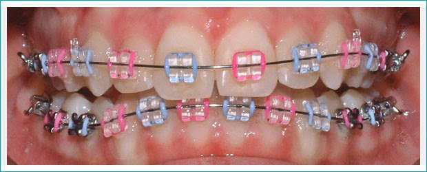 Ortodontik maksud