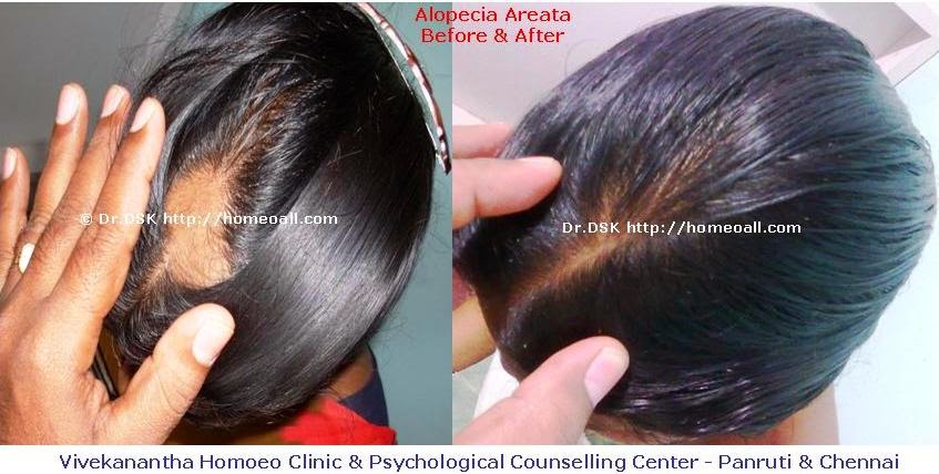 Vivekanantha Homeo Clinic & Psychological Counseling Centre, Chennai:  Suffering with multiple bald patches of Alopecia Areata hair falling, is  there is any best treatment for bald patches of alopecia areata in  homeopathy?