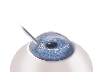 Queratoplastia conductiva