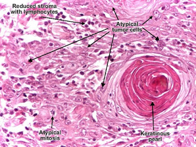 Histology and explanation of Squamous cell carcinoma (skin)