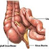 Obat Alternatif Radang Usus Herbal thumbnail