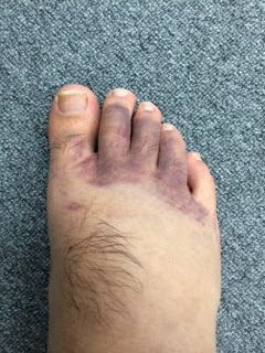 かかとだけで終わると思ったら指先にも…