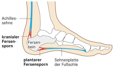 Tiossulfat in den Injektionen von der Schuppenflechte