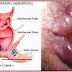 Obat Ambeien Ampuh thumbnail