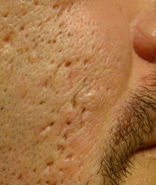 Steroid cream for acne scars