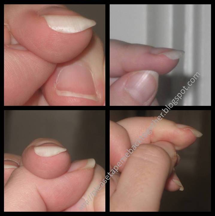 Please Tape Me Back Together Jumping A Hurdle Tomorrow Week My Weird Fingernails
