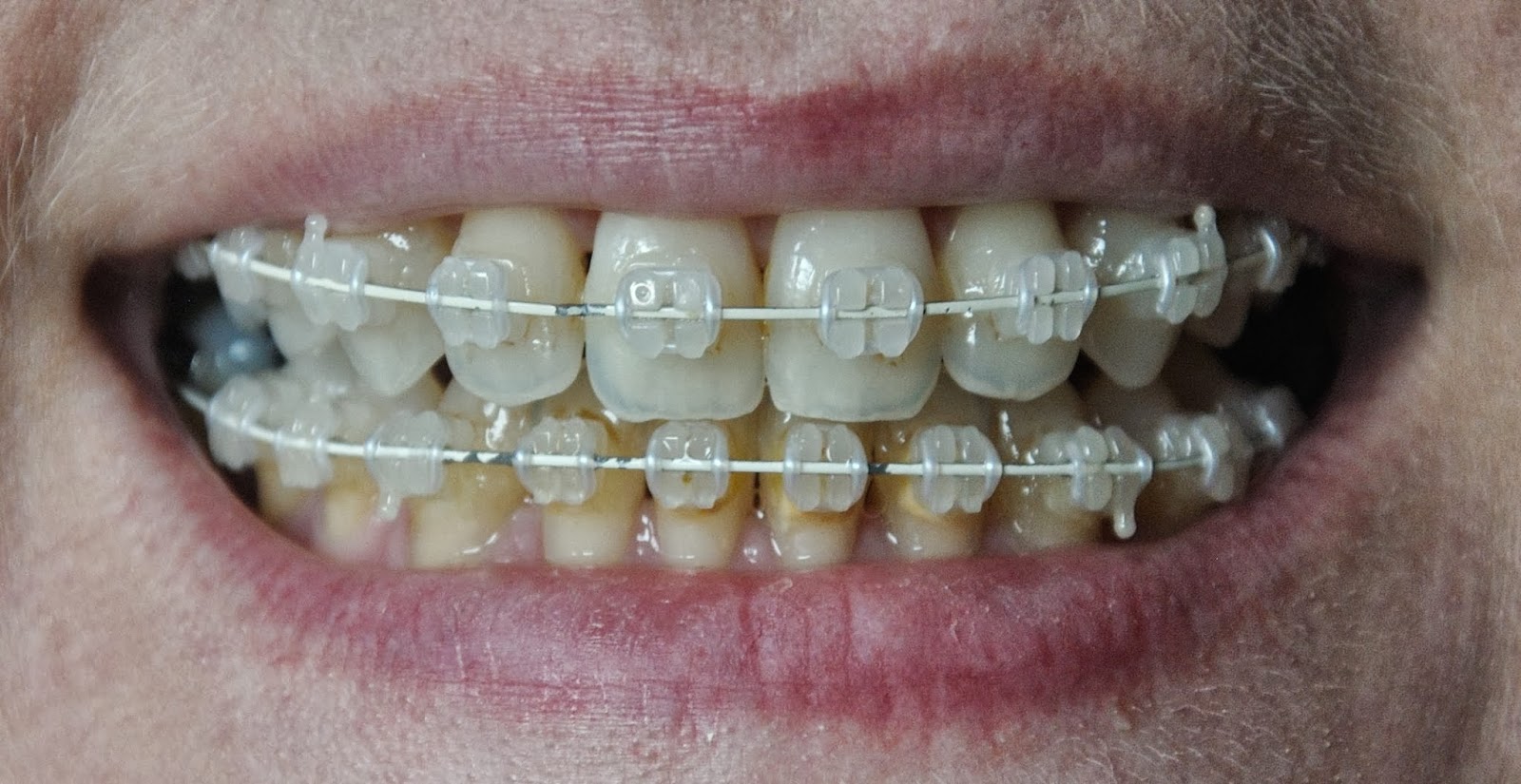 Things that make me go aagghh! My latest brace adjustment appointment