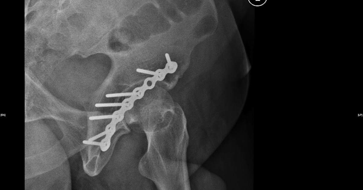 Types Of Hip Fractures - Fracture Treatment