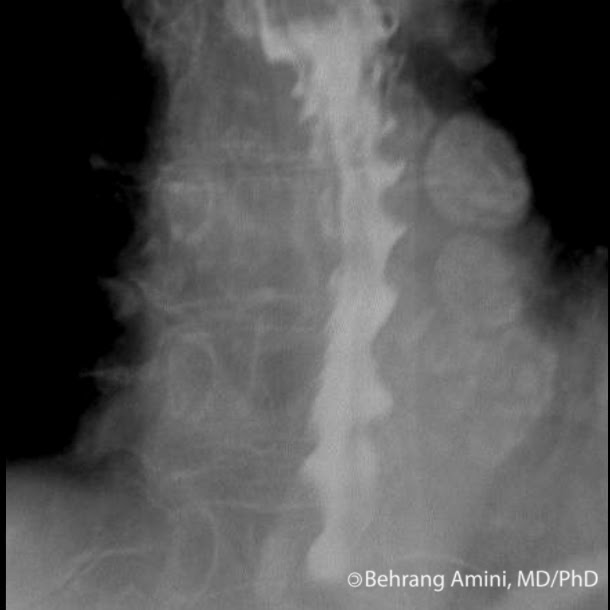 Roentgen Ray Reader Corkscrews in Radiology