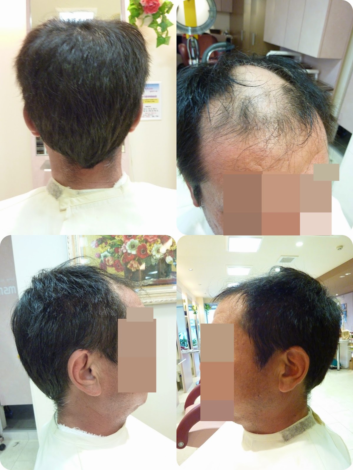 頭 頂部 へこみ 頭頂部が固くでこぼこする 血行不良やストレスによる影響