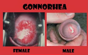 Gonore pada pria dan wanita Gonore pada pria dan wanita