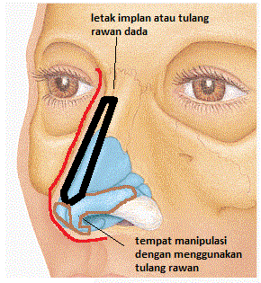 Bedah Plastik Surabaya