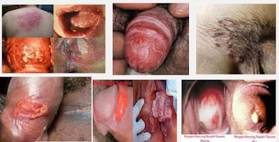 Penyakit kulit dengan ciri ciri gatal gatal panas melepuh pada kemaluan