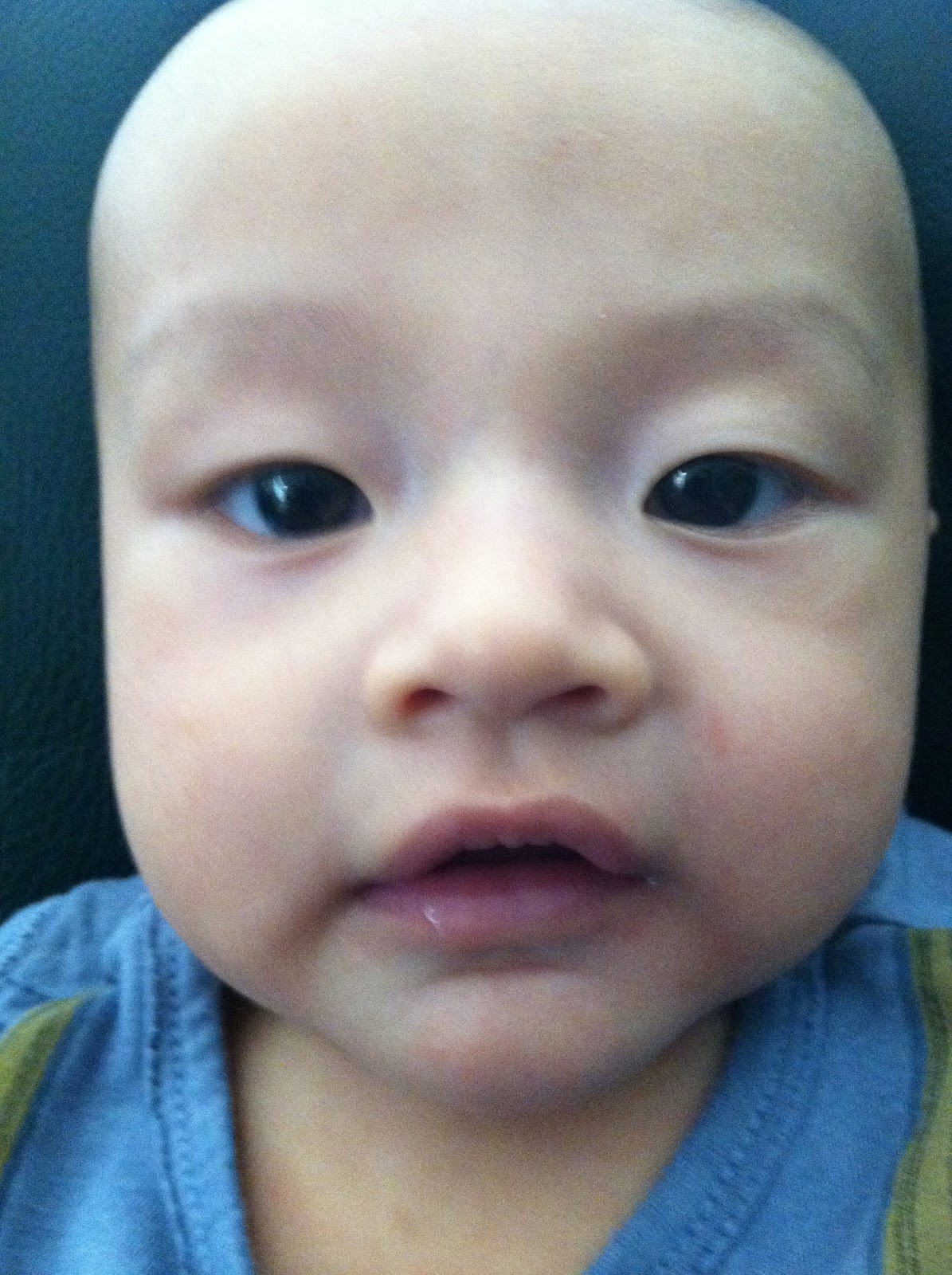 Caucasian Double Eyelids