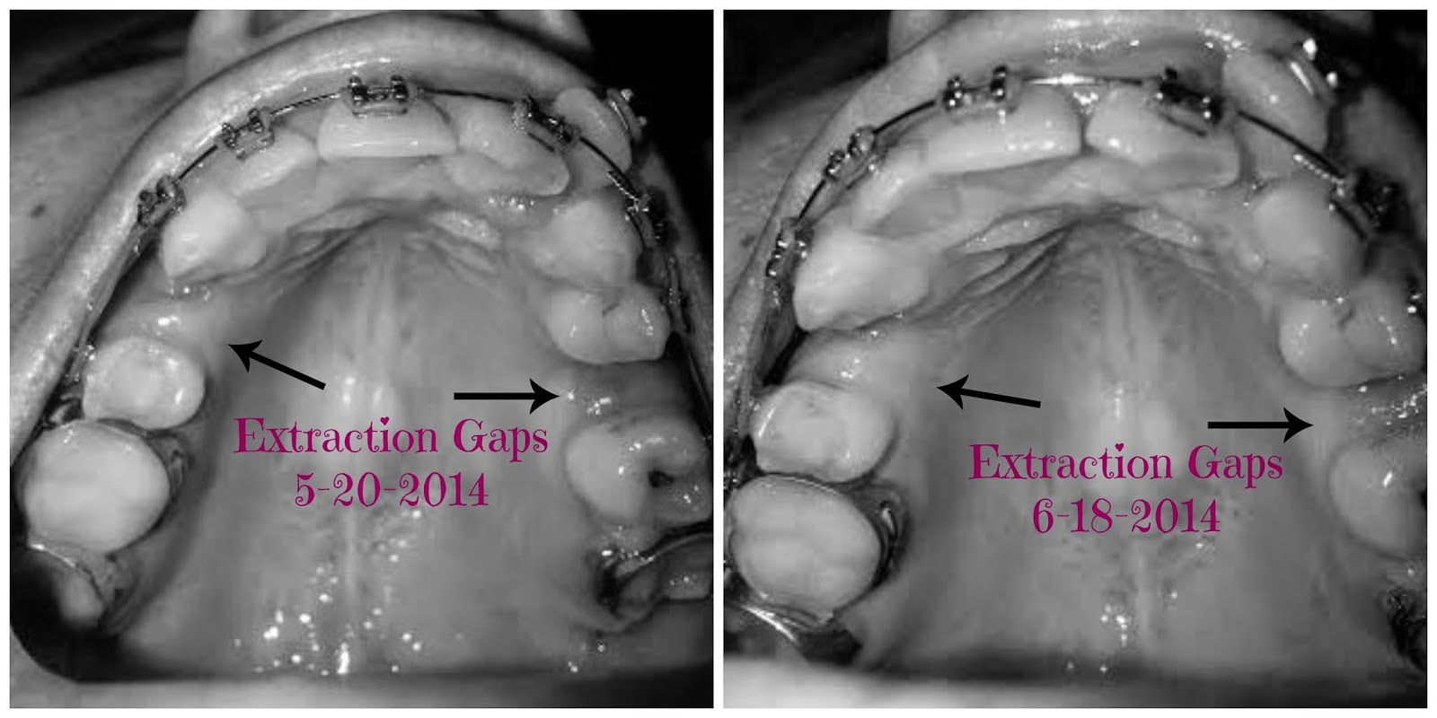 Adult Braces My Journey 3rd Month Update with Braces