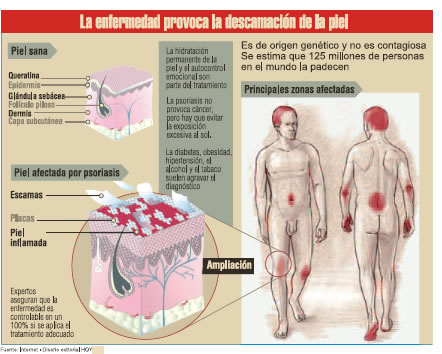 Mejor del medio de la psoriasis