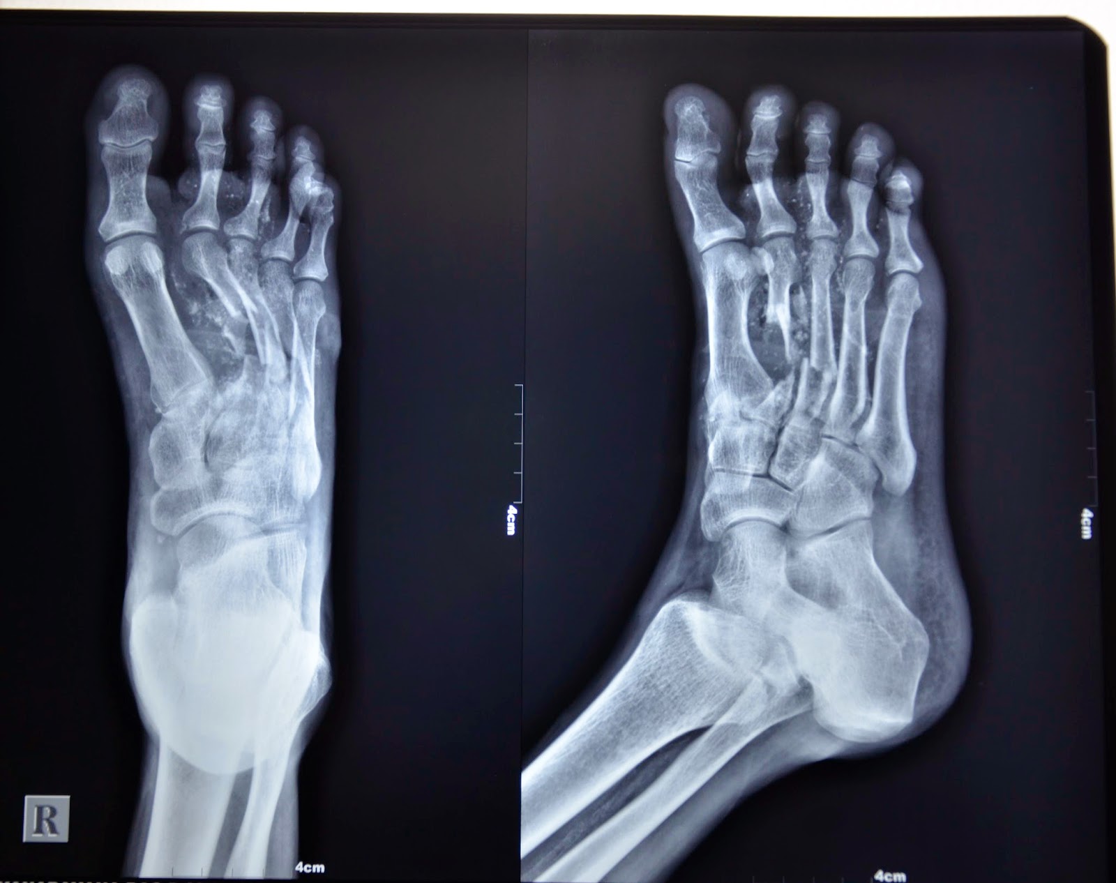 CRUSH INJURY FOOT, LOWER LIMB INJURIES AND LIMB SALVAGE CRUSH INJURY