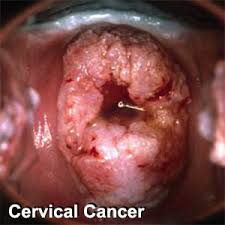 Cervical