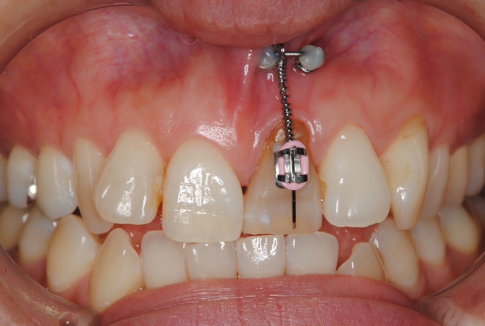 IMPLANT SURGEON Dr. KATO in JAPAN ESTHETIC IMPLANT PLACEMENT FOLLOWING