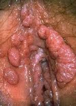 Obat Alami Kondiloma Obat Alami Kondiloma