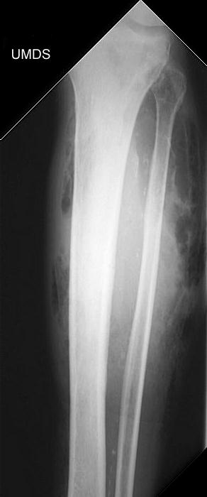 Gangrene Gas
