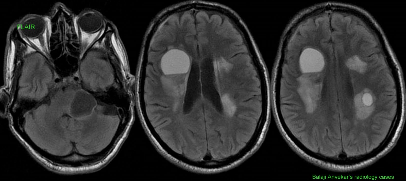 Dr Balaji Anvekar's Neuroradiology Cases Hydatid cysts brain