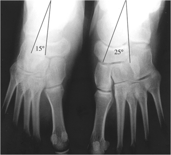 MBBS Medicine (Humanity First) Congenital Talipes