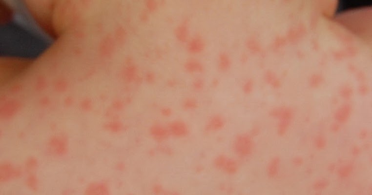 am i allergic to clindamycin