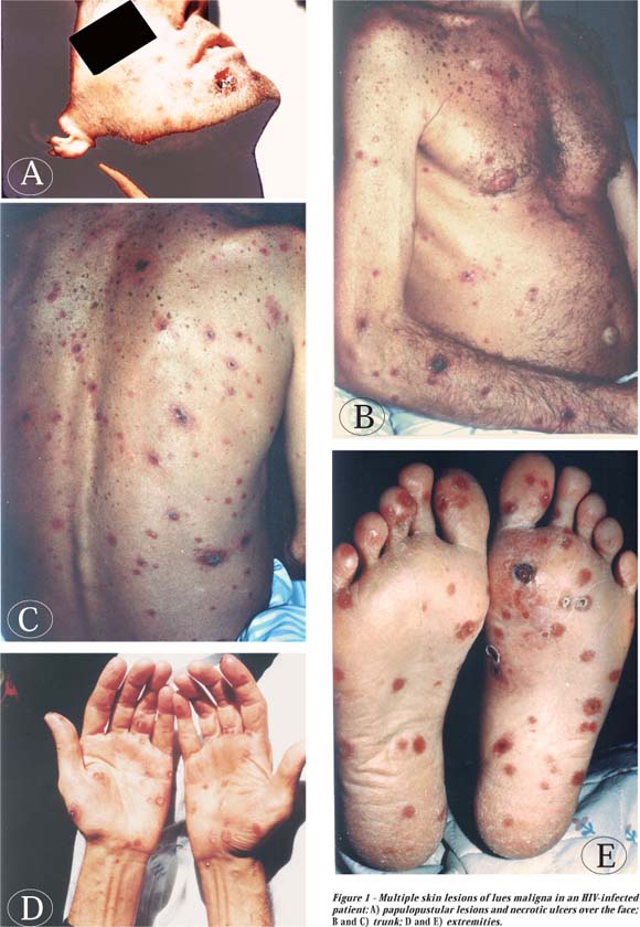 Apa sih penyakit Siphilis itu ? INTERESTING AND FABULOUS