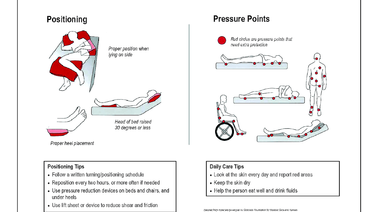 Causes Of Pressure Ulcers Ulcer Choices