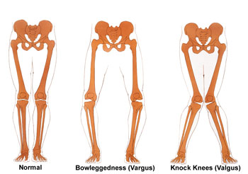 Normal Knee Alignment