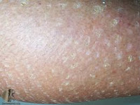 Cuidados De La Piel -  el invierno la piel seca con picazón