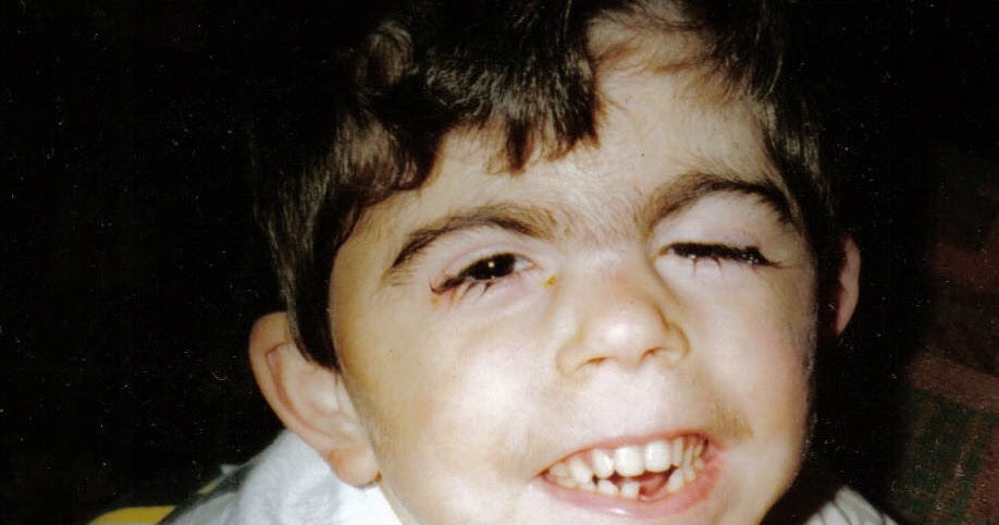 SÍNDROME DE CORNELIA DE LANGE Tipos de Grados En Síndrome Cornelia De