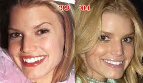 Jessica Simpson Plastic Surgery