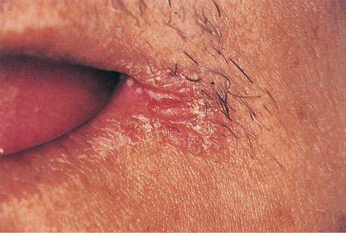 Topical steroids perioral dermatitis