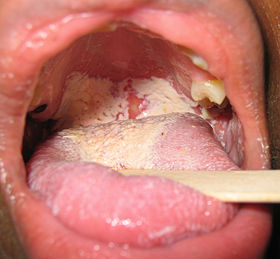 Oral thrush icd 10