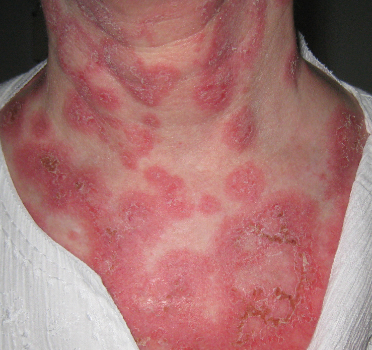 Lupus Definition, Diagnosing and Treatments Ain Health