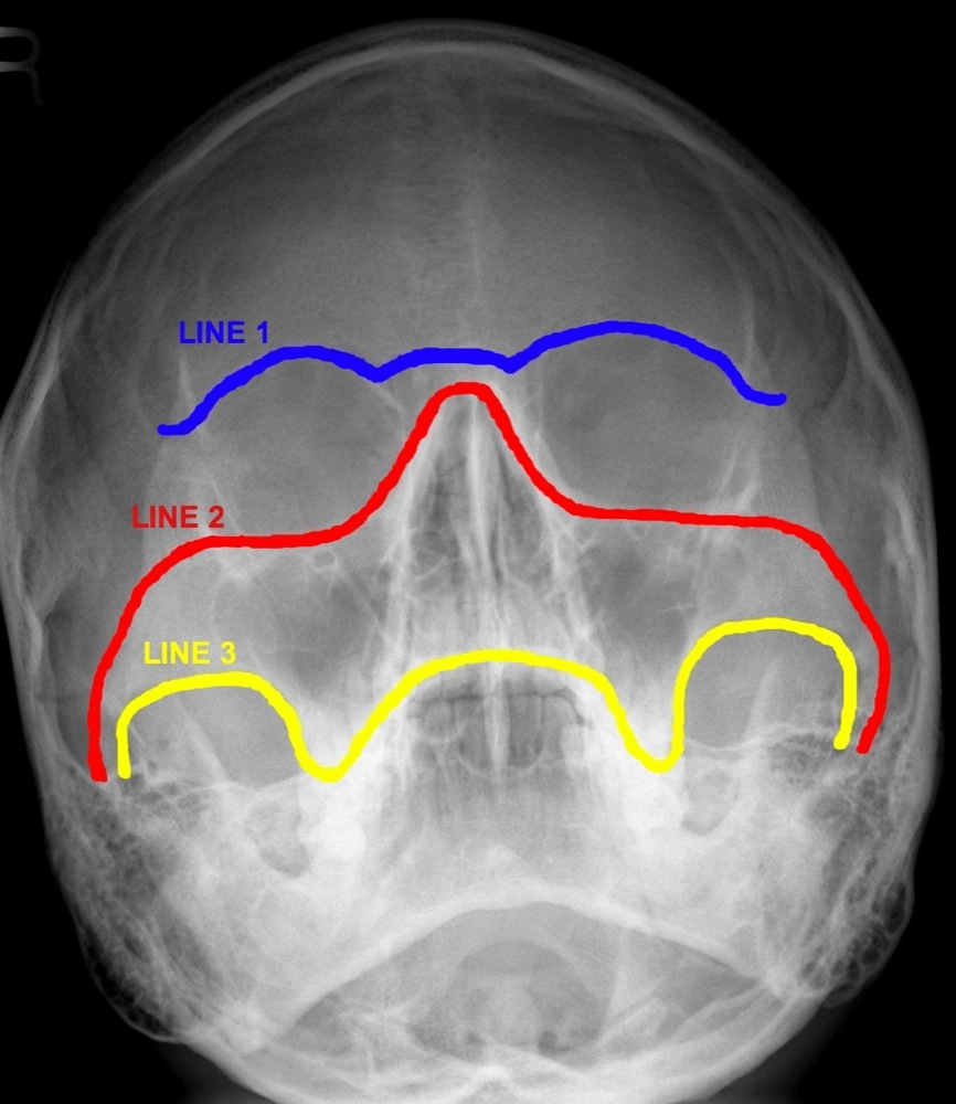 ON RADIOLOGY What are Occipitomental Views ? And lines for inspection.